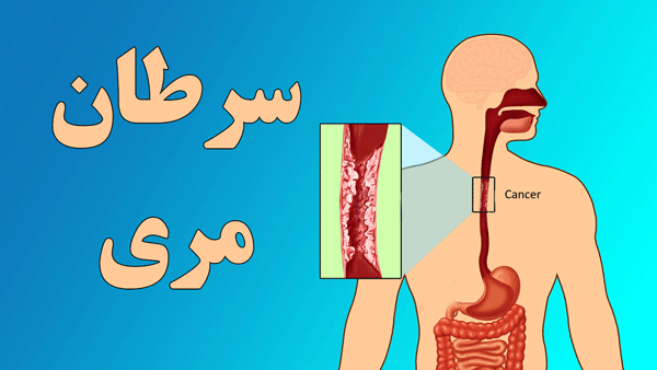 روش های پیشگیری از ابتلا به سرطان مری